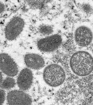 Brasil investiga dois casos suspeitos da varíola do macaco