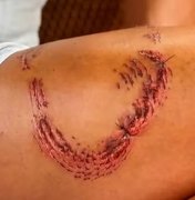 Turista mostra perna com marcas de mordida de tubarão em Noronha e fala sobre dor