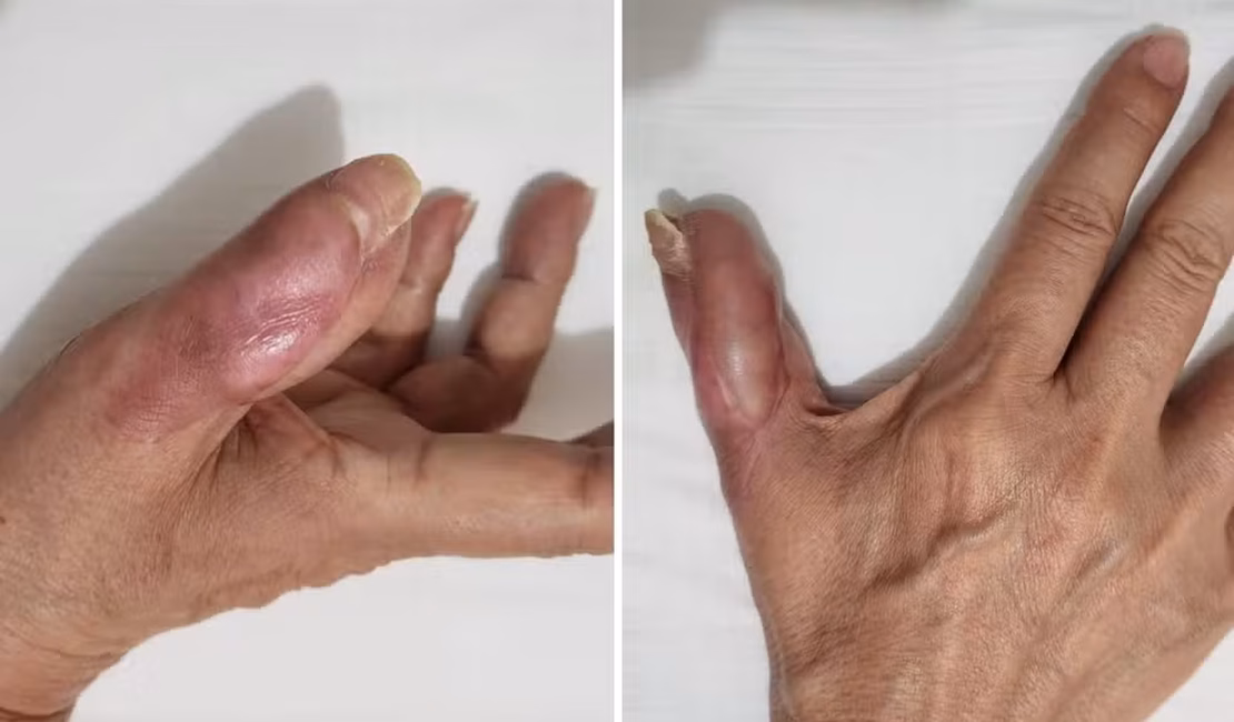 Mulher perde parte do dedo após fazer as unhas em salão e ter infecção