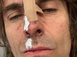 Liam Gallagher mostra rosto machucado depois de cair de helicóptero após show