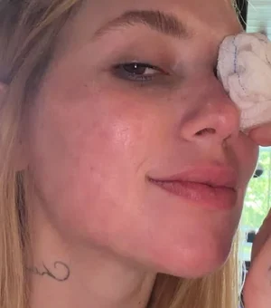 Virginia surge com lesão no olho após acidente envolvendo a filha