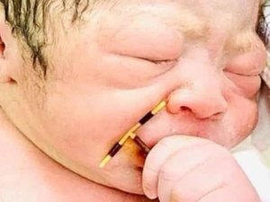 Bebê nasce agarrado ao DIU que mãe tinha colocado e foto viraliza
