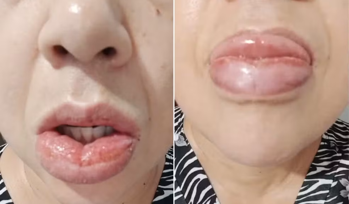 Colgate decide parar de fabricar o creme dental Clean Mint após reações alérgicas
