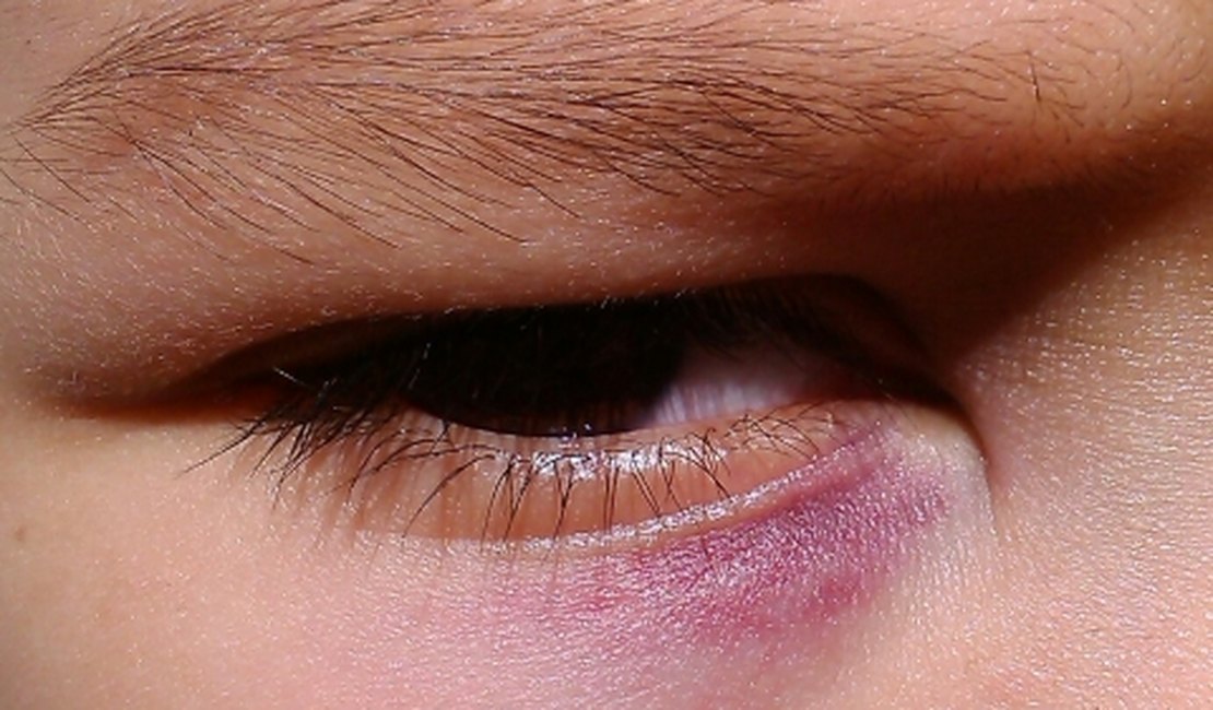 Criança quase tem olho perfurado após sofrer agressão em sala de aula