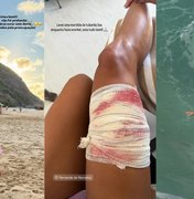 Turista é mordida por tubarão durante mergulho em Fernando de Noronha