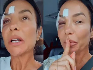 Com olho roxo, Ivete Sangalo comemora alta hospitalar após desmaio e brinca: 'Maquiagem diferente'