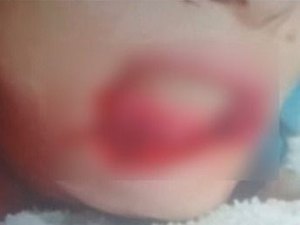 Polícia apura agressão brutal contra jovem que teve lábios arrancados pelo companheiro em Viçosa