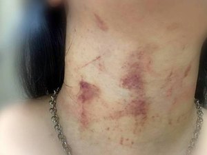 Jovem de 20 anos é estrangulada e espancada pelo ex-namorado