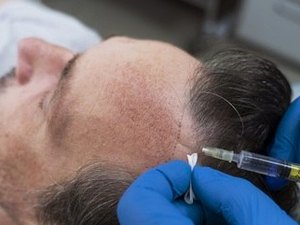 Gasto com transplante e implante de cabelo sobe 60% em um ano