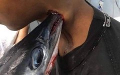 Peixe-agulha cravado no pescoço de adolescente na Indonésia