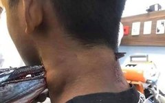 Peixe-agulha cravado no pescoço de adolescente na Indonésia