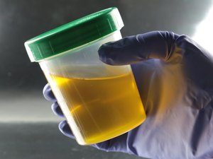 Cientistas registram primeiro caso de pessoa que urina álcool