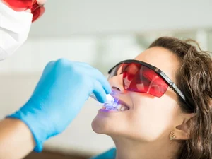 Uso de clareamento dental é seguro e não enfraquece os dentes, afirmam especialistas