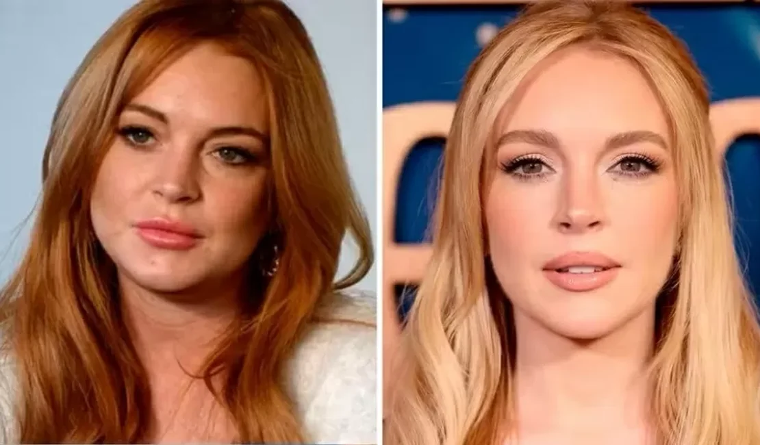 Lindsay Lohan gastou R$ 1,7 milhão para rejuvenescer, diz especialista