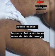 Criança de 1 ano morre com suspeita de meningite, em Maceió