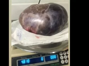 Em cirurgia de emergência, médicos retiram tumor de 5 kg de paciente