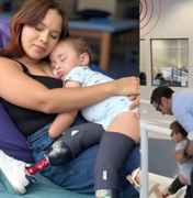 Após desvio de R$ 113 mil pelo pai, bebê amputado de Murici começa a andar com próteses