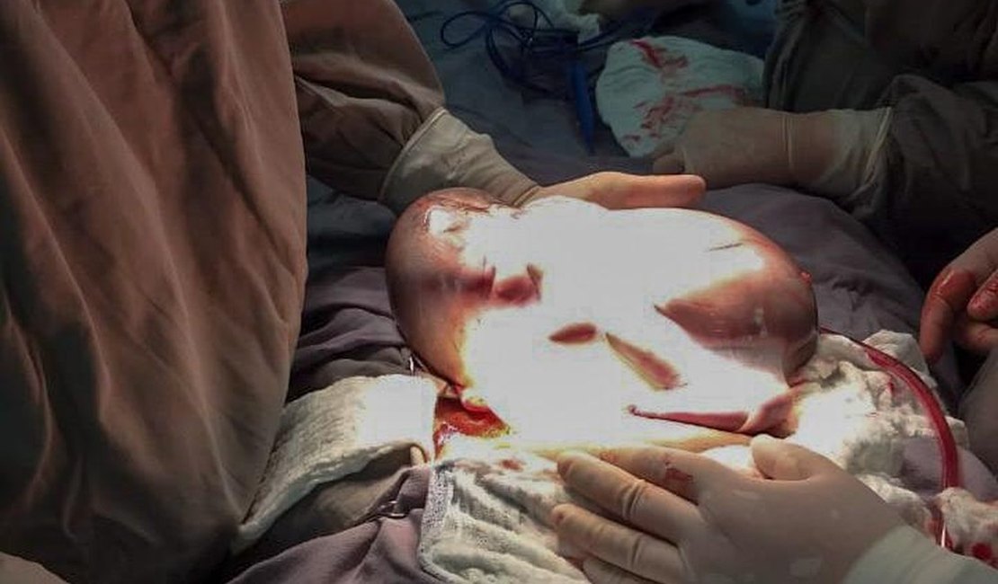 Bebê nasce dentro da bolsa amniótica durante parto raríssimo em SP