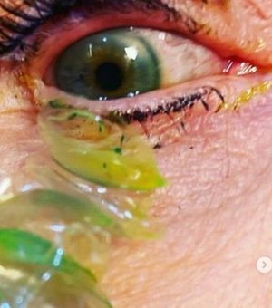 Oftalmologista retira 23 lentes de contato perdidas em olho de paciente; veja vídeo