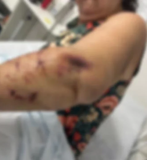 Turista atacada por três cães na orla de Paripueira perde movimentos dos dedos