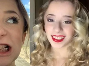 Garota com dentes 'transparentes' gasta R$ 49 mil para ganhar novo sorriso