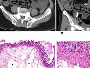 Imagens revelam ferimentos no intestino causadas pelo novo coronavírus