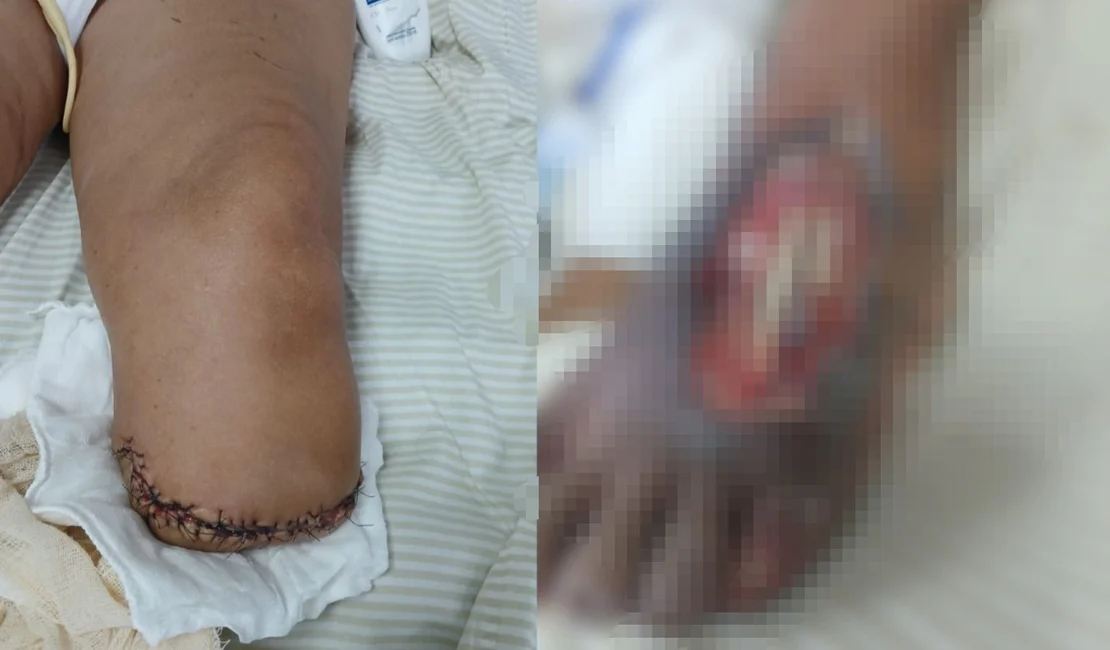 Idosa que corria risco de perder o pé após suposta negligência médica tem parte da perna amputada
