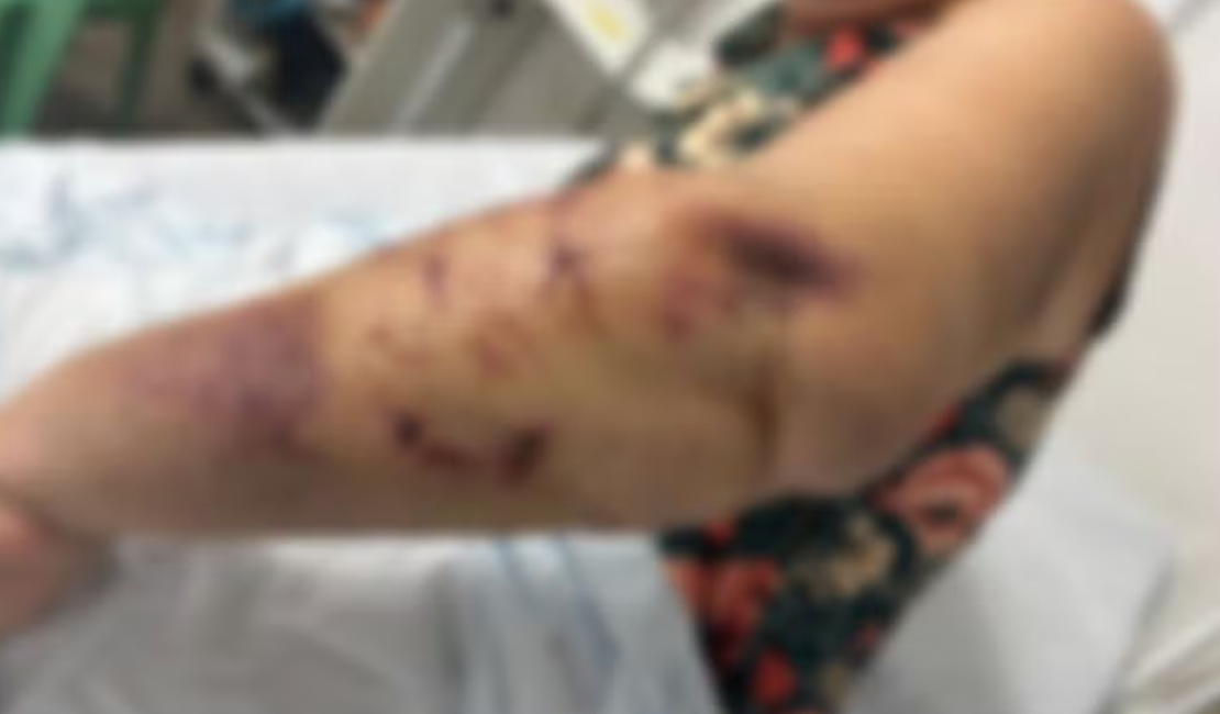 Turista atacada por três cães na orla de Paripueira perde movimentos dos dedos