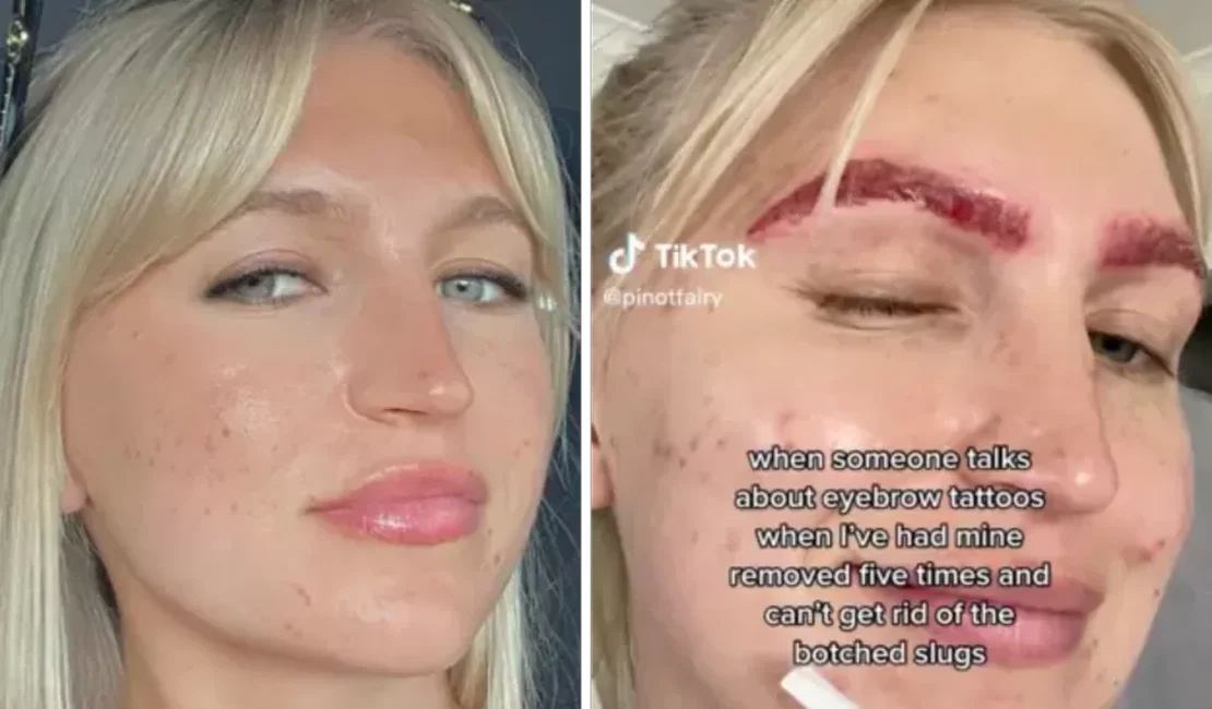 TikToker tenta remover tatuagem na sobrancelha e resultado choca web