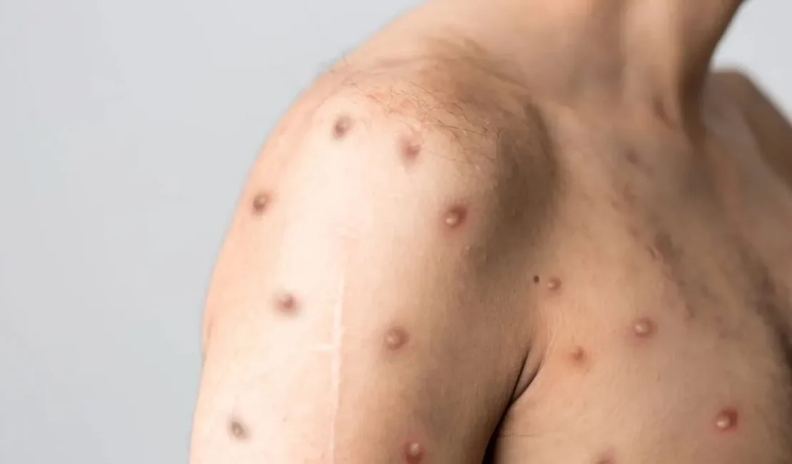 Mpox chega a 81 casos no Brasil em 2026; veja sintomas e quando suspeitar