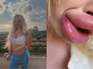 Influencer não consegue mais fechar a boca após preenchimentos labiais