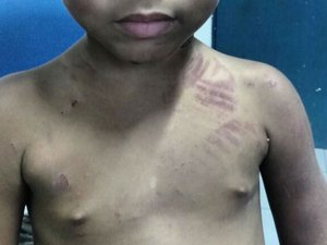 Criança de três anos é espancada pelo pai e tem pimenta colocada no órgão genital