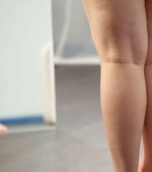 Lipedema: Muito Além da 'celulite'; entenda a condição