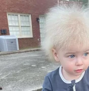 Criança faz sucesso nas redes por condição rara do cabelo