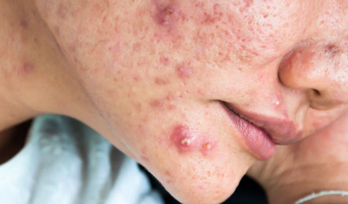 Adolescentes com crises graves de acne aguardam há oito meses por medicamento