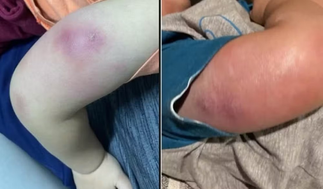 Criança é hospitalizada com infecção grave após vacinação em posto de saúde de Maceió