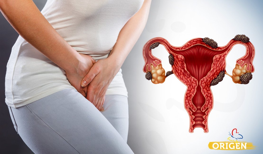 Endometriose: um alerta para o coração da mulher