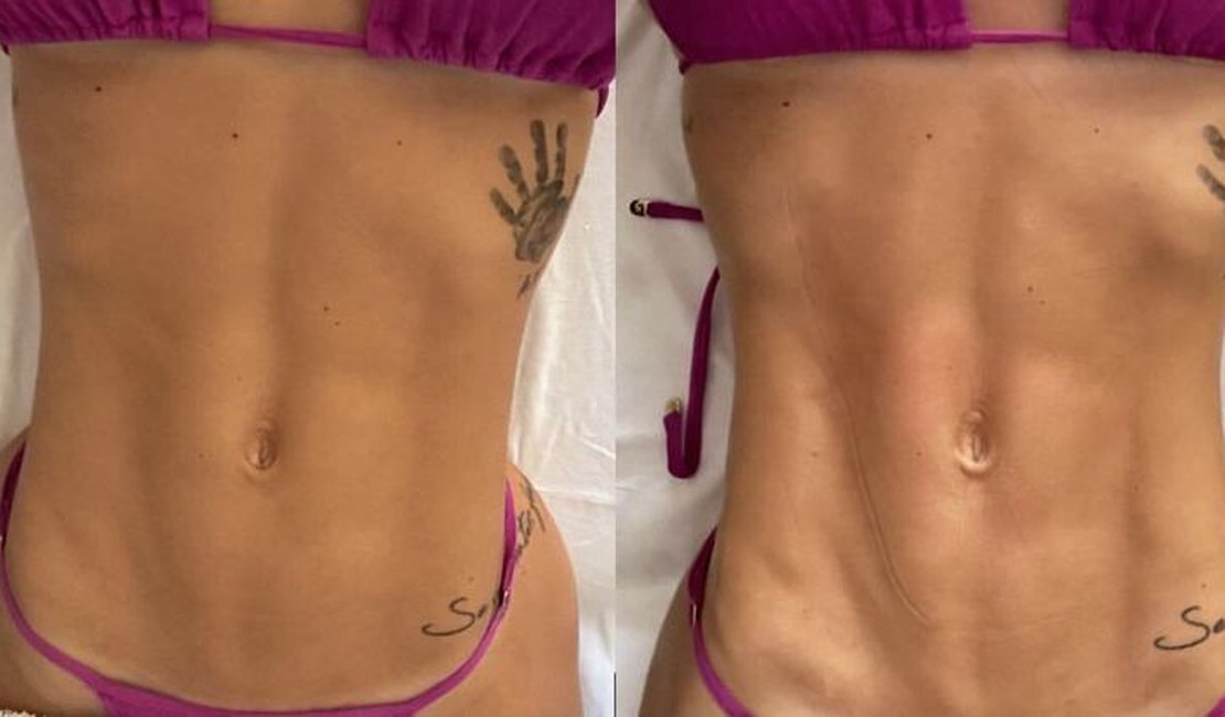 Virginia Fonseca mostra a barriga antes e depois de fazer massagem modeladora