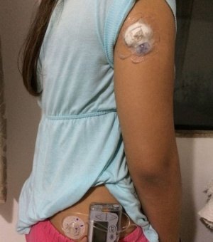 Estudante é impedida de fazer Enem por uso de bomba de insulina