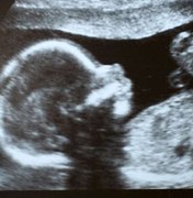 A delicada cesariana feita em bebê para retirar feto 'gêmeo'