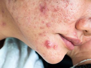 Adolescentes com crises graves de acne aguardam há oito meses por medicamento