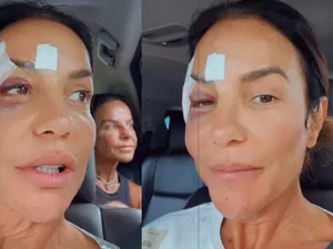 Ivete Sangalo faz cirurgia no maxilar após queda em casa; saiba como está a cantora