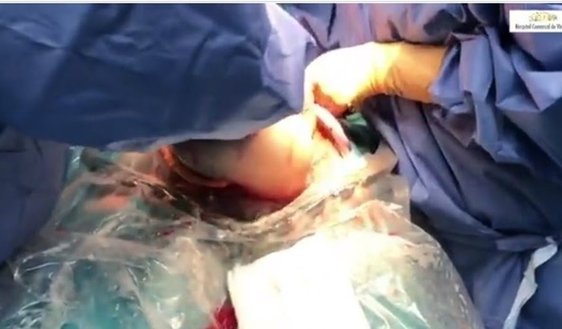 Vídeo mostra nascimento raro de bebê empelicado na Espanha