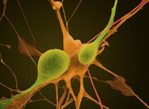 Pesquisa desvenda causa da Esclerose Lateral Amiotrófica
