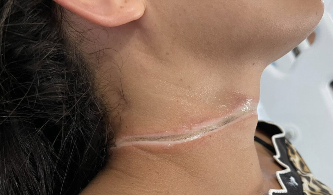 Garota fica com pescoço ferido após ser atingida por fio de internet que caiu de poste