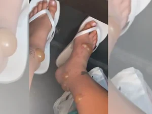 Lua de mel vira pesadelo após reação chocante a picadas de insetos