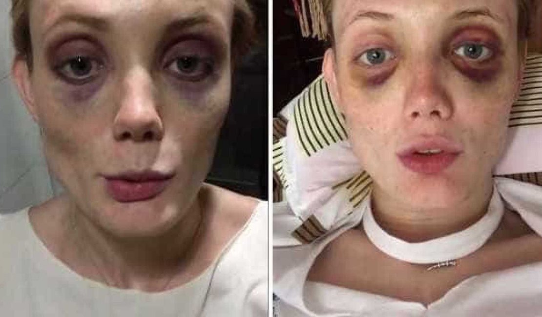 Modelo mostra hematomas e denuncia agressões de ex-namorado nas redes sociais