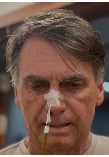 Ex-presidente Bolsonaro deixa UTI nesta quarta-feira (30), 17 dias após cirurgia
