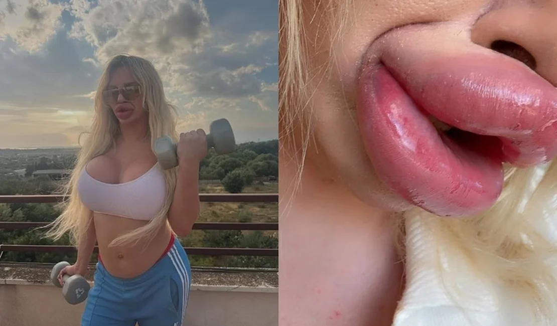 Influencer não consegue mais fechar a boca após preenchimentos labiais