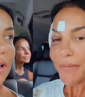 Ivete Sangalo faz cirurgia no maxilar após queda em casa; saiba como está a cantora